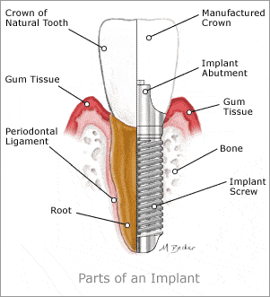 shows the different parts of a dental implant