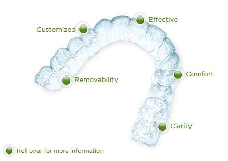 shows features of invisalign.