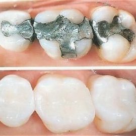 Composite Fillings (tooth colored)