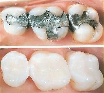 Composite Fillings (tooth colored)