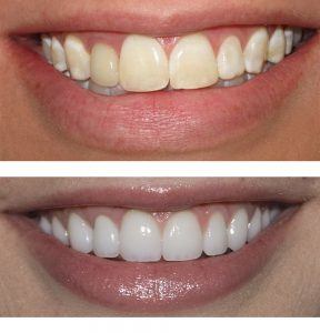 veneers are a great way to change your smile